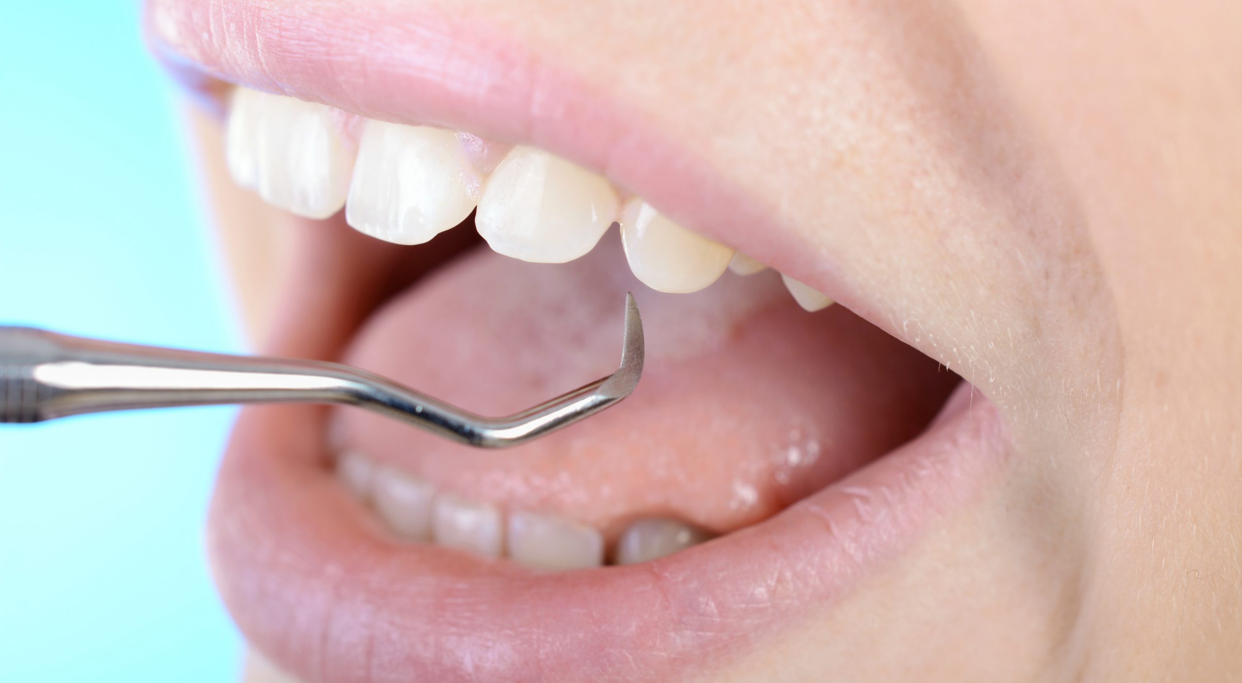 Zahnbehandlung durch Zahnarzt mit Haken